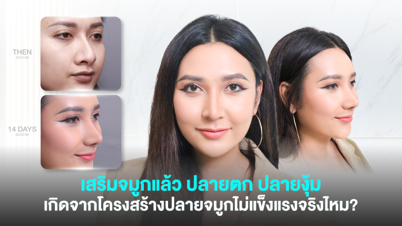 nose-tip-drooping-after-rhinoplasty