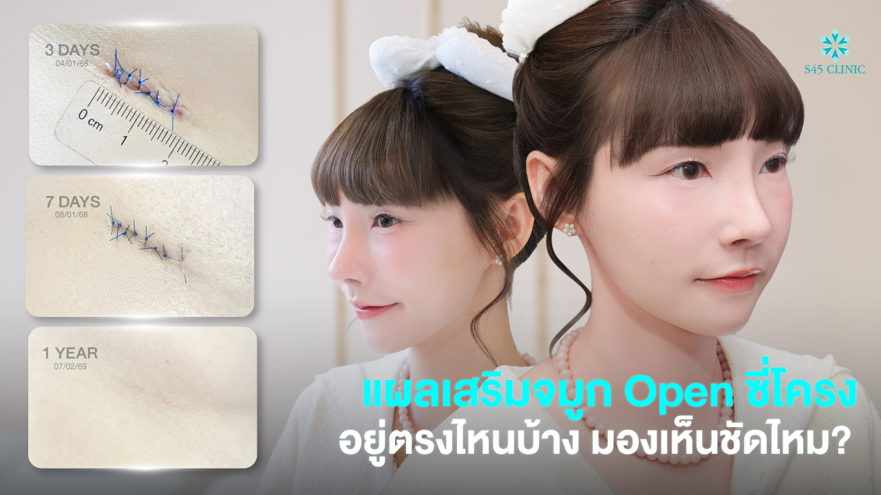 open-rib-rhinoplasty-scar-care