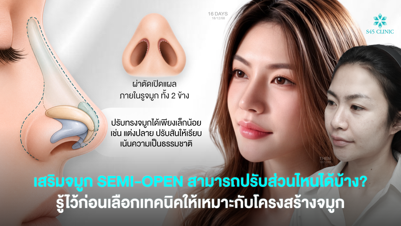 semi-open-rhinoplasty-nose-structure