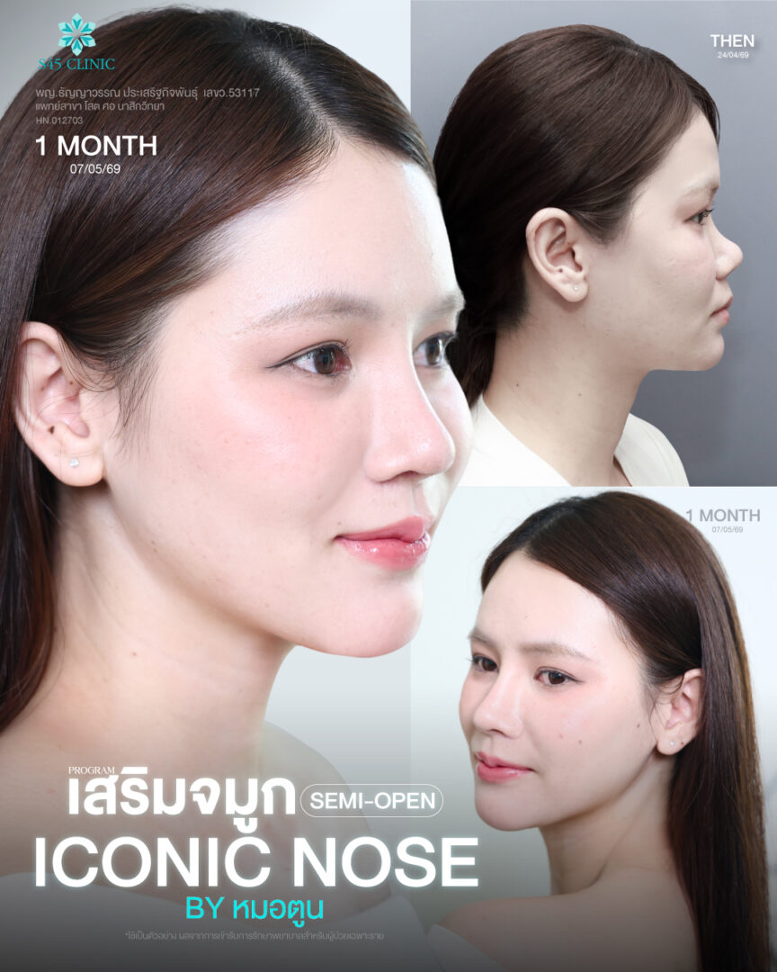 จมูกเนื้อน้อย จมูกสั้น อยากได้ทรงเกาหลี ทำ Semi-Open ได้ไหม? 4 จมูกสั้น