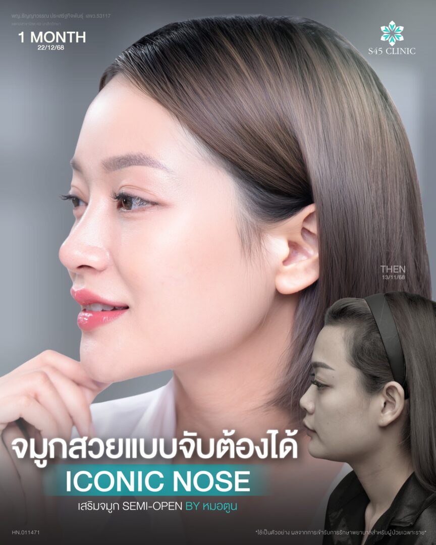 จมูกเนื้อน้อย จมูกสั้น อยากได้ทรงเกาหลี ทำ Semi-Open ได้ไหม? 3 จมูกสั้น เตี้ย