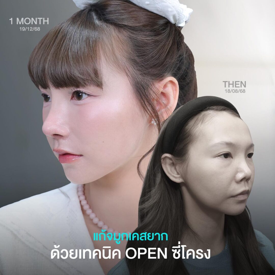 จมูกเนื้อน้อย