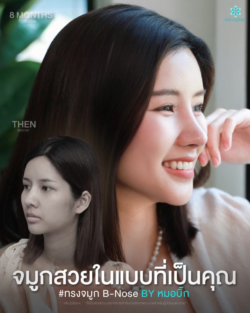 จมูกเบี้ยว เอียง