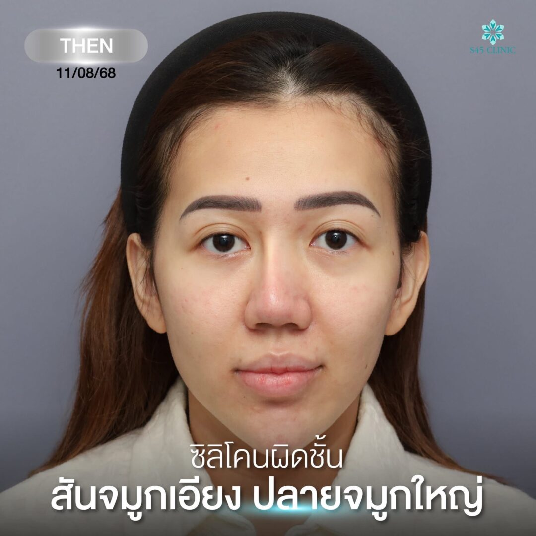 จมูกเอียง