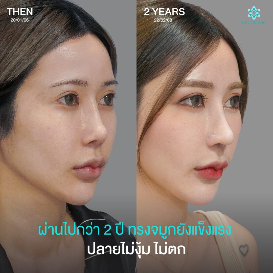 จมูกแข็งเเรง