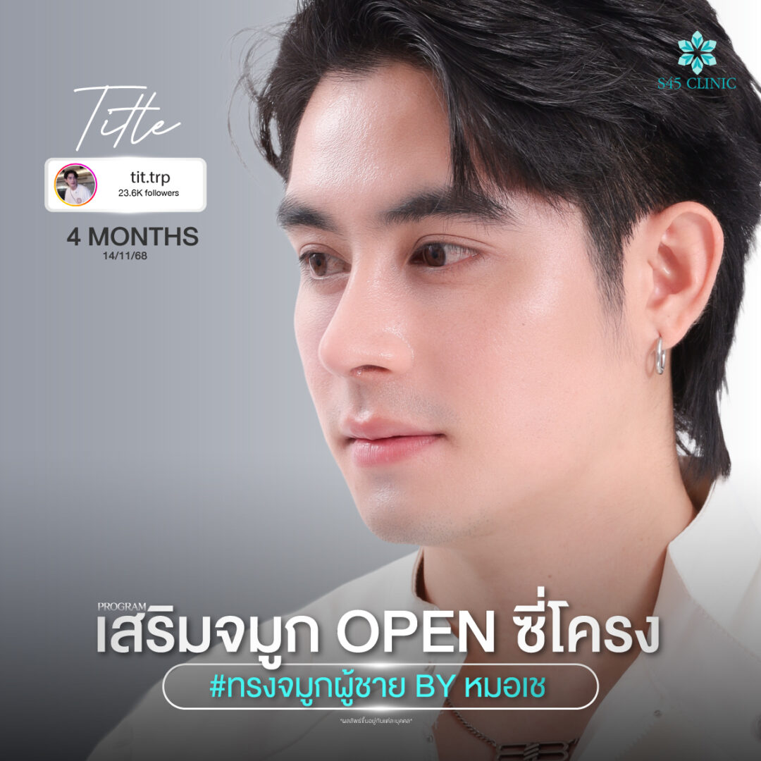 ทรงจมูก คมชัด