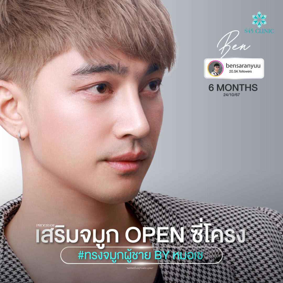 ทรงจมูก คมชัด s45 clinic