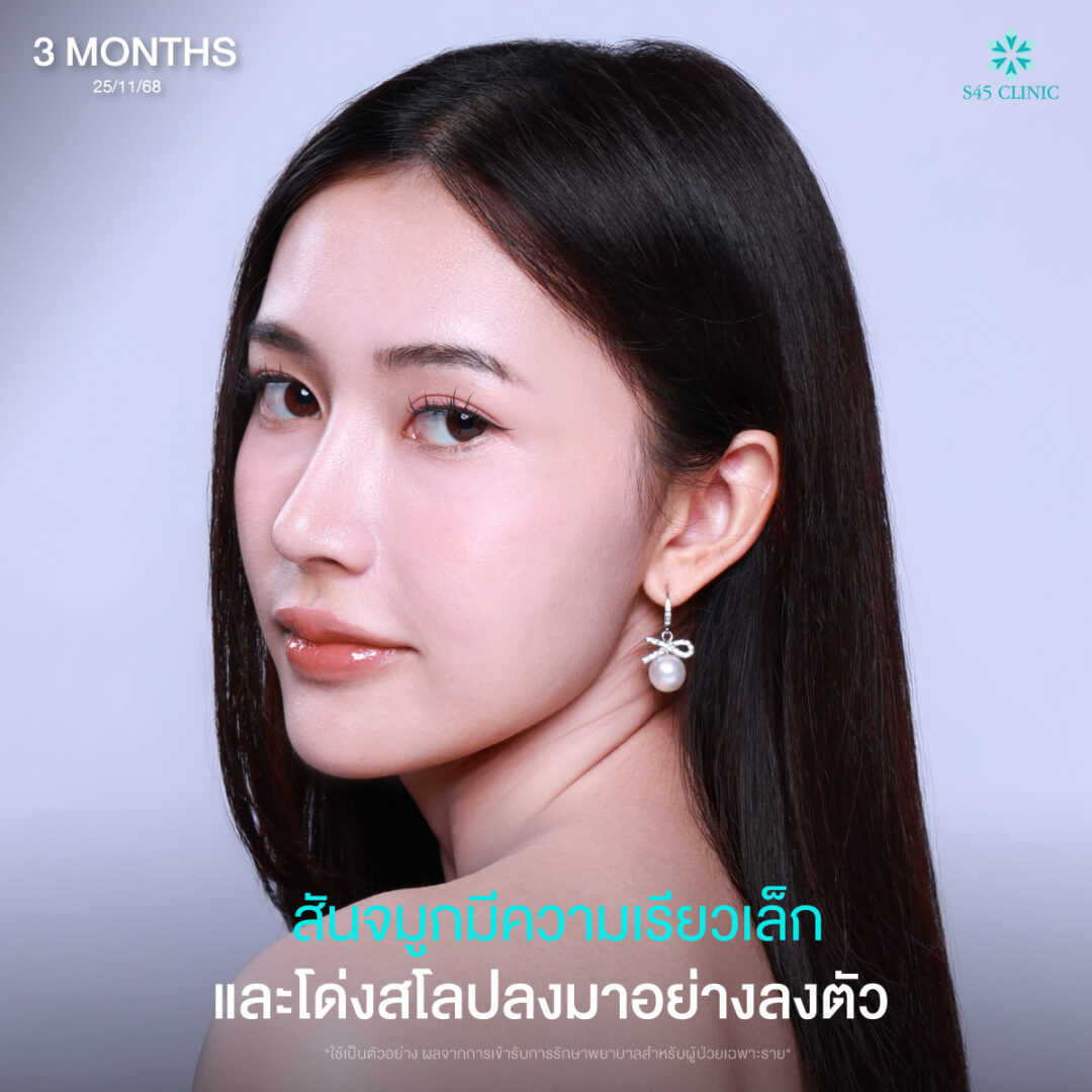 ทรงจมูกธรรมชาติ 08