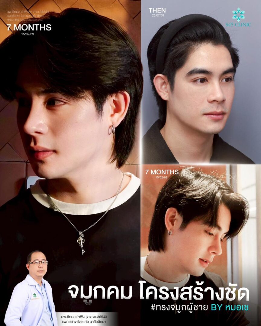 ทรงจมูกผู้ชาย s45 clinic