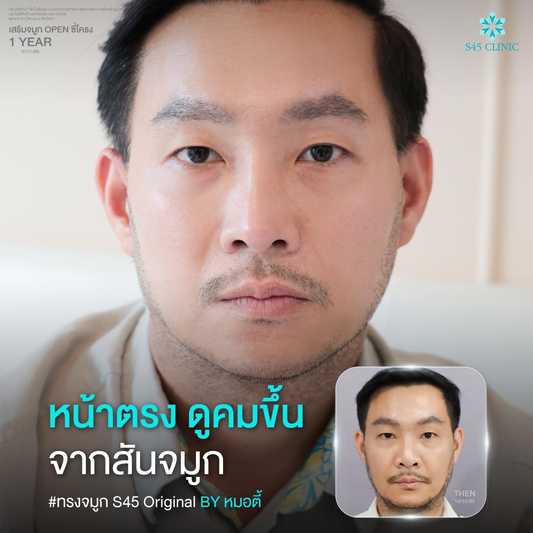 ทรงจมูกผู้ชาย คม ๆ