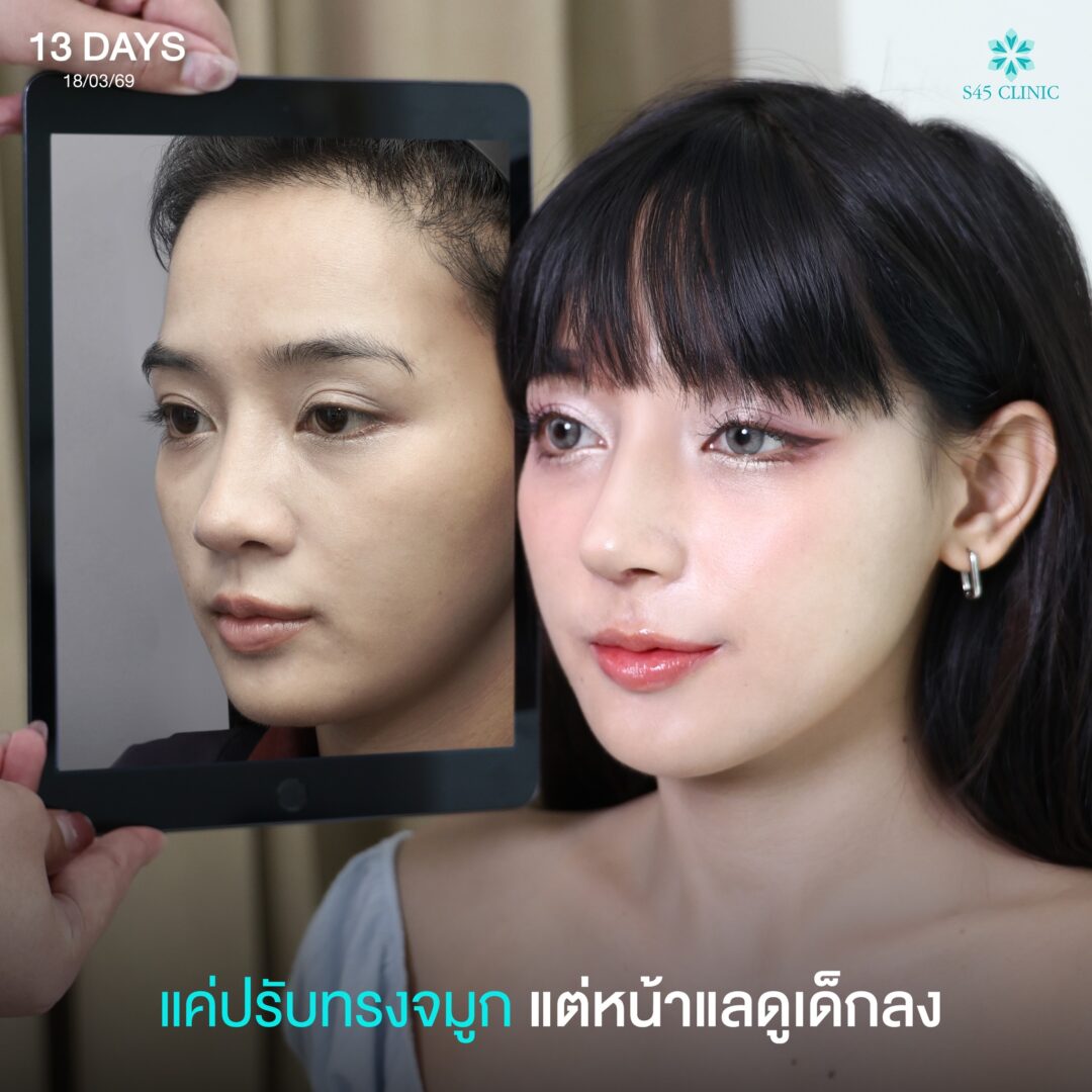 ทรงจมูกสโลปดูละมุน