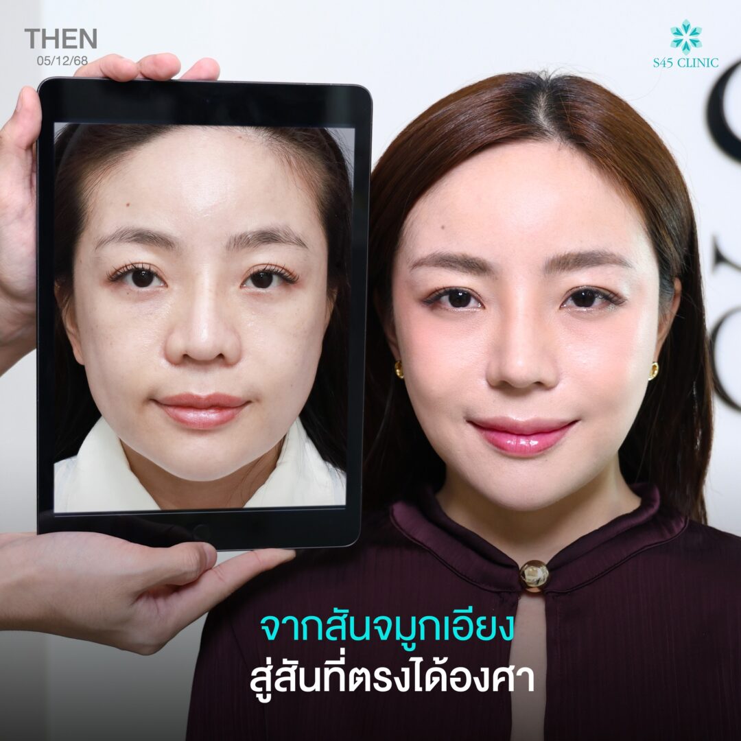 สันจมูกเอียง
