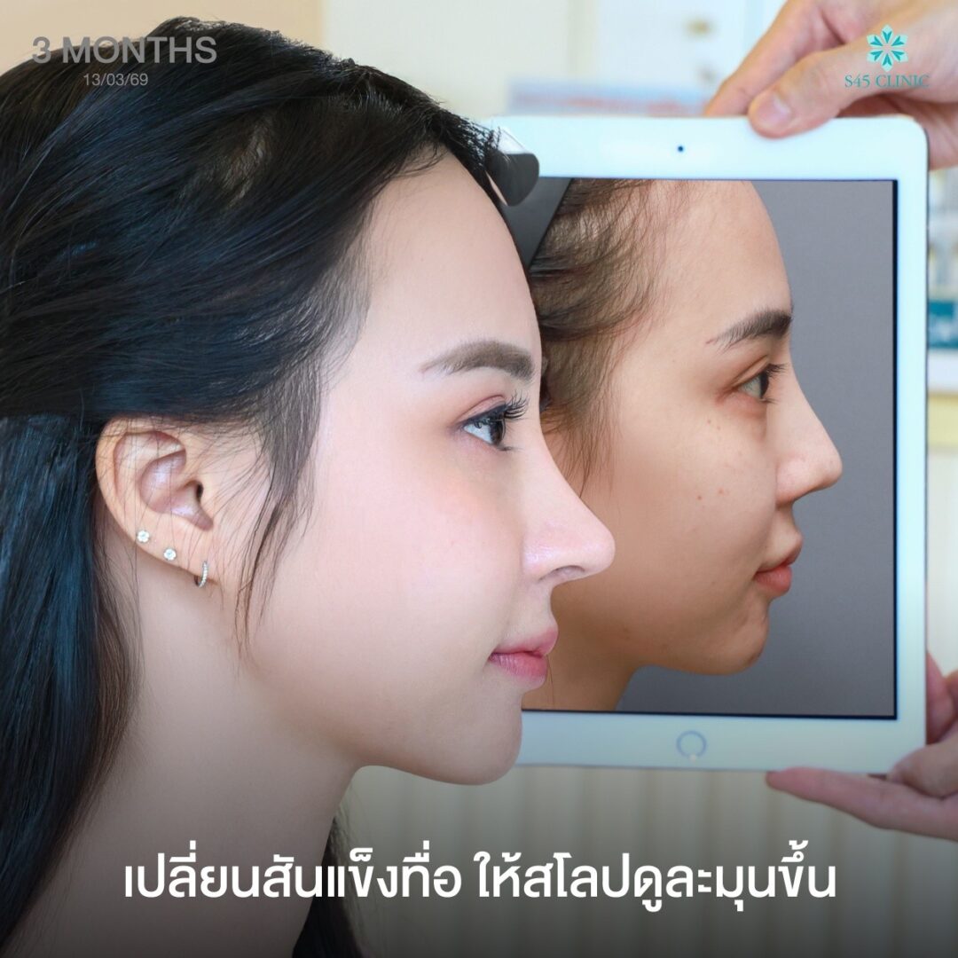 สโลปปลายพุ่ง