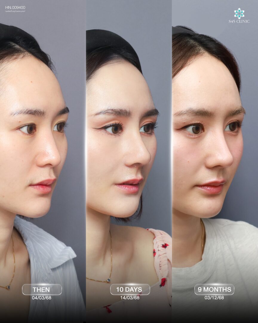 สโลปปลายพุ่ง s45 clinic
