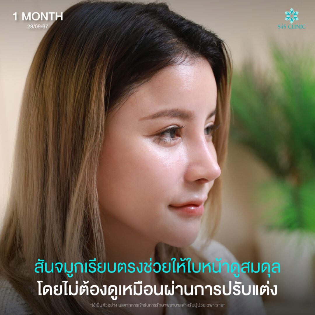 เสริมจมูก Open 04