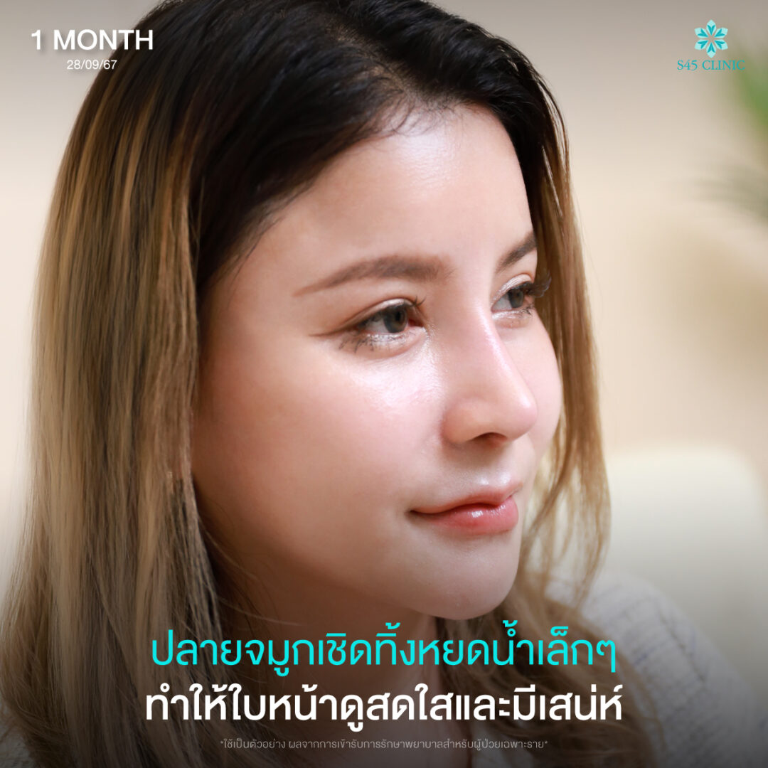 เสริมจมูก Open 05