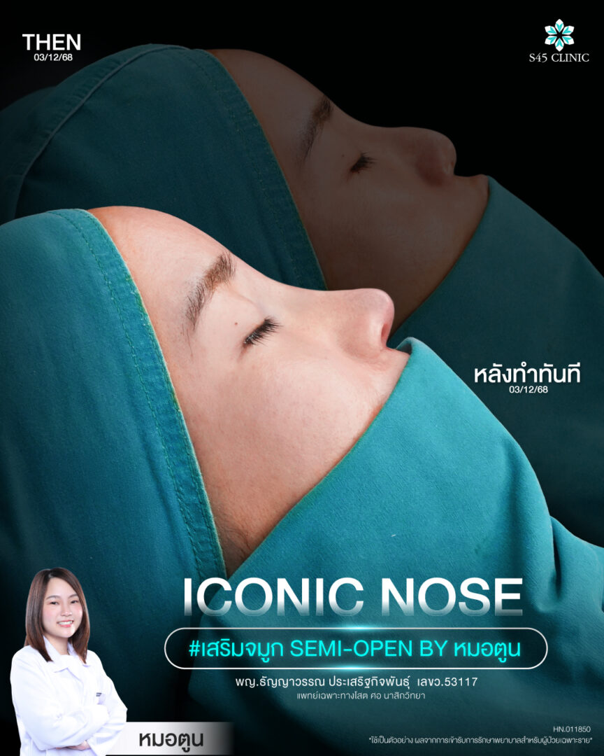 เสริมจมูก Semi-Open สามารถปรับส่วนไหนได้บ้าง? รู้ไว้ก่อนเลือกเทคนิคให้เหมาะกับโครงสร้างจมูก 2 เสริมจมูก Semi-Open 011