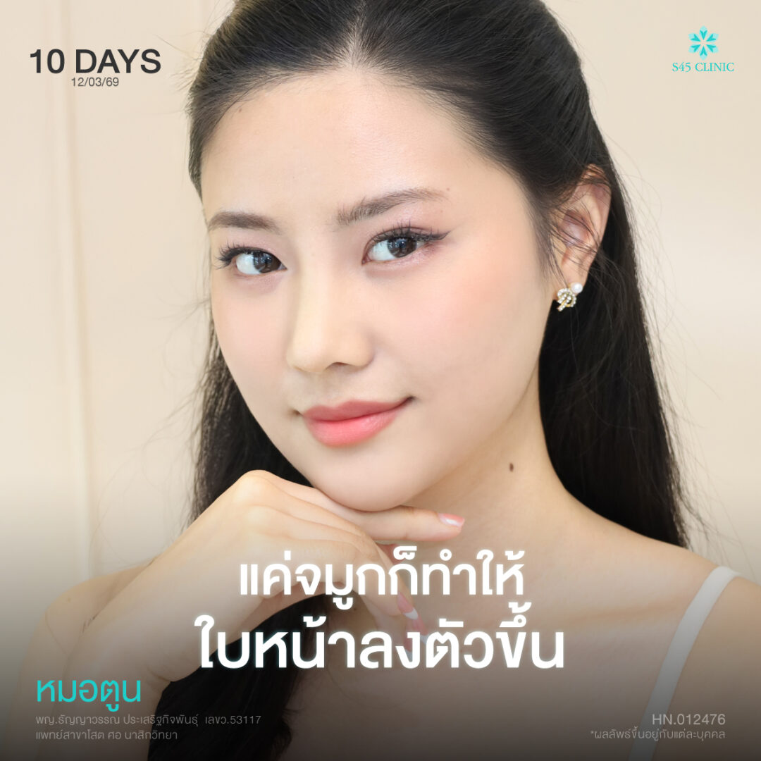 เสริมจมูก Semi-Open 02