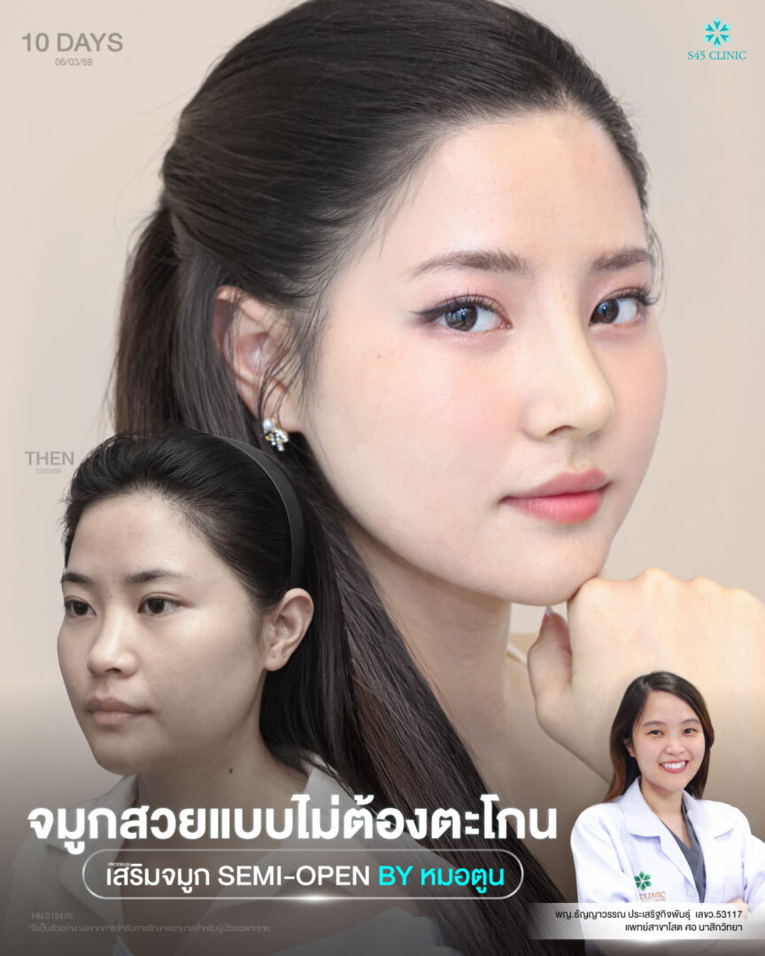 เสริมจมูก Semi-Open 04