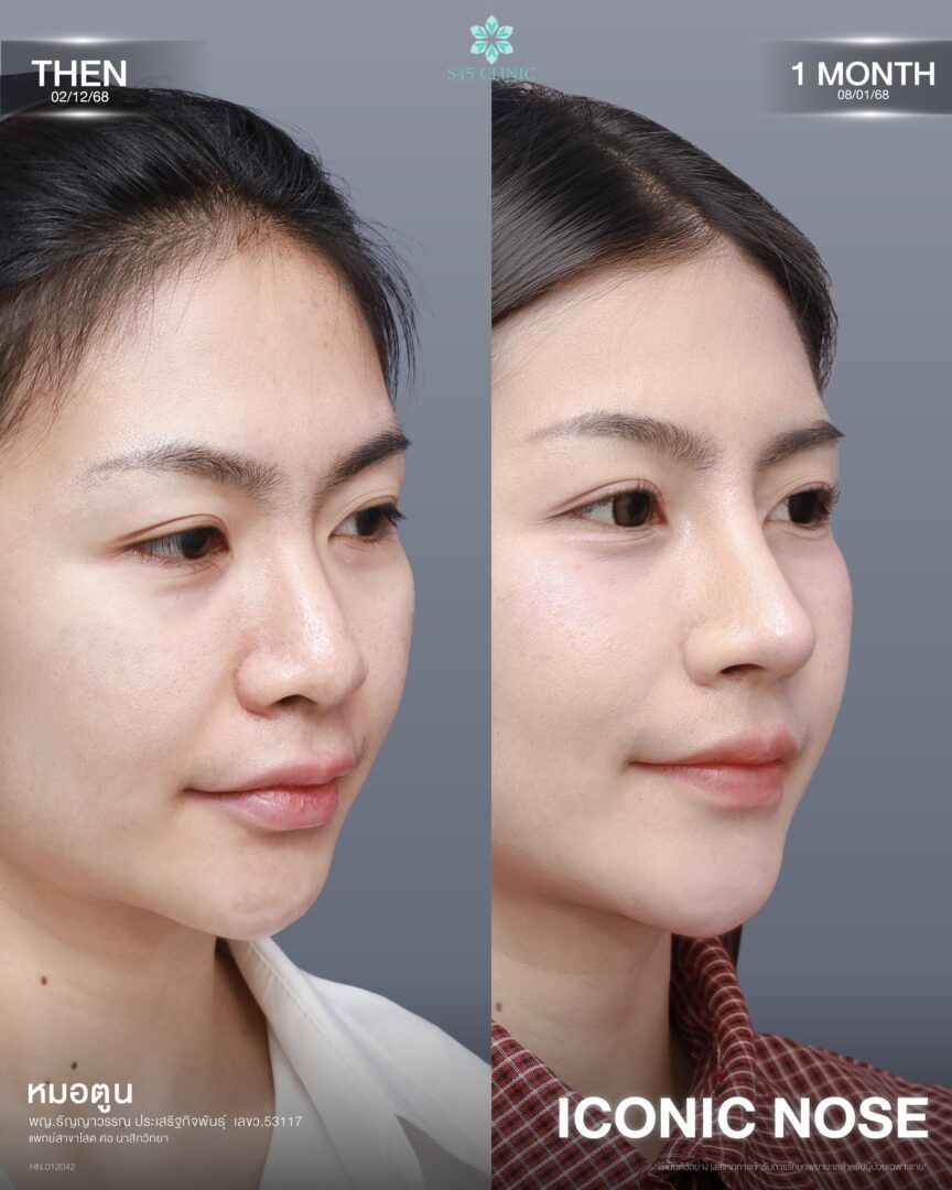 เสริมจมูก Semi-Open สามารถปรับส่วนไหนได้บ้าง? รู้ไว้ก่อนเลือกเทคนิคให้เหมาะกับโครงสร้างจมูก 6 เสริมจมูก Semi-Open 08
