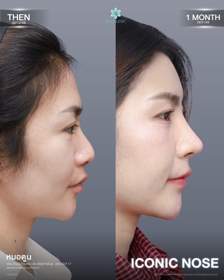 เสริมจมูก Semi-Open สามารถปรับส่วนไหนได้บ้าง? รู้ไว้ก่อนเลือกเทคนิคให้เหมาะกับโครงสร้างจมูก 5