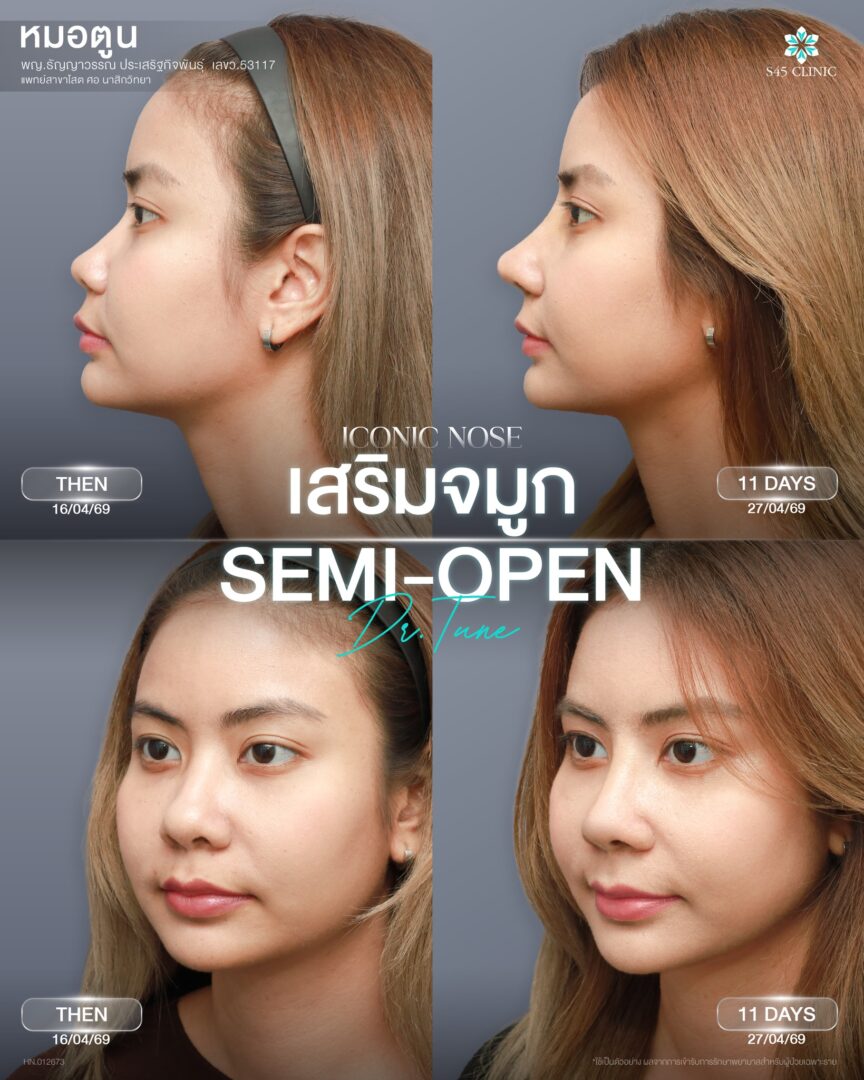 เสริมจมูก semi-open 05