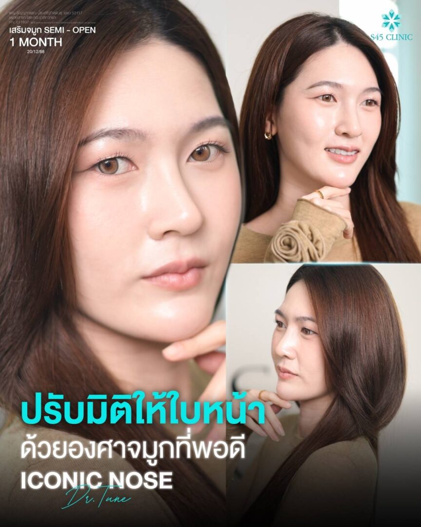 เสริมจมูก semi-open 06