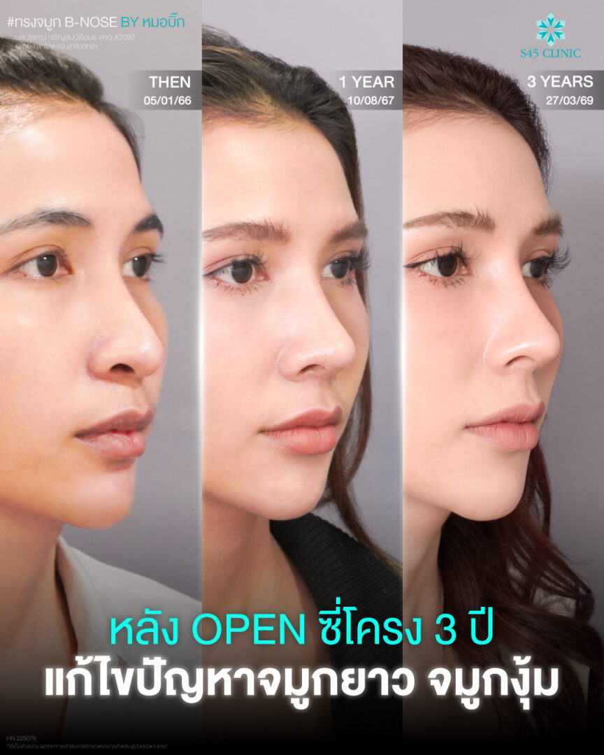 เสริมจมูกปลายงุ้ม