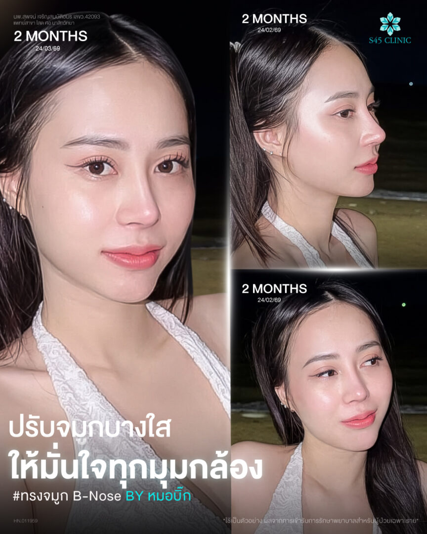 เสริมจมูกผู้หญิงที่ไหนดี 1