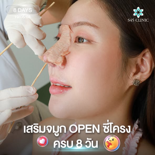 เสริมจมูกสโลป