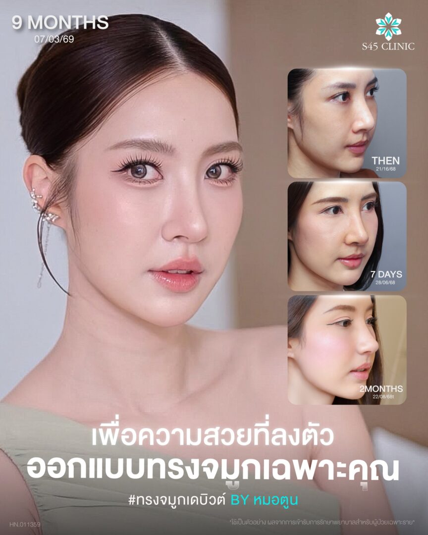 อยากเสริมจมูกให้เข้ากับหน้า ต้องดูอะไรบ้างก่อนเลือกทรง? 2 เสริมจมูกเข้ากับใบหน้า 01