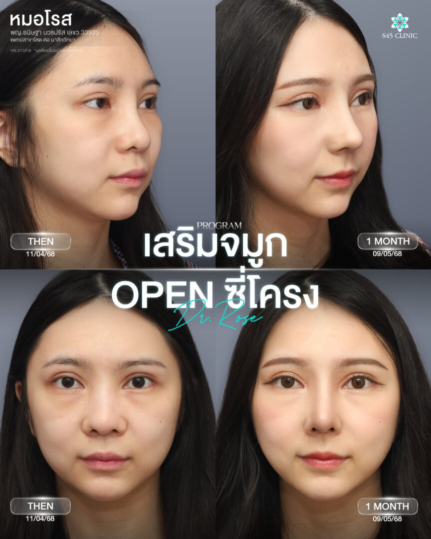 อยากเสริมจมูกให้เข้ากับหน้า ต้องดูอะไรบ้างก่อนเลือกทรง? 5 เสริมจมูกเข้ากับใบหน้า 02