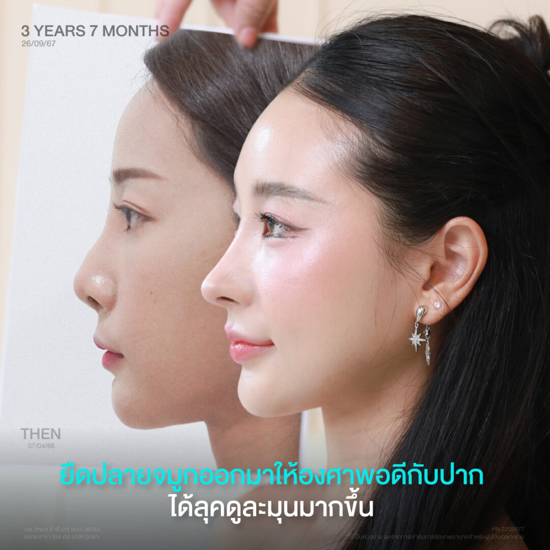 อยากเสริมจมูกให้เข้ากับหน้า ต้องดูอะไรบ้างก่อนเลือกทรง? 4 เสริมจมูกเข้ากับใบหน้า 03