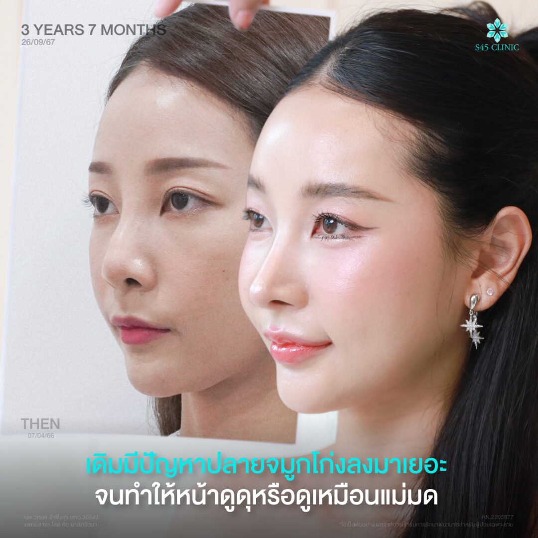 อยากเสริมจมูกให้เข้ากับหน้า ต้องดูอะไรบ้างก่อนเลือกทรง? 3 เสริมจมูกเข้ากับใบหน้า 04