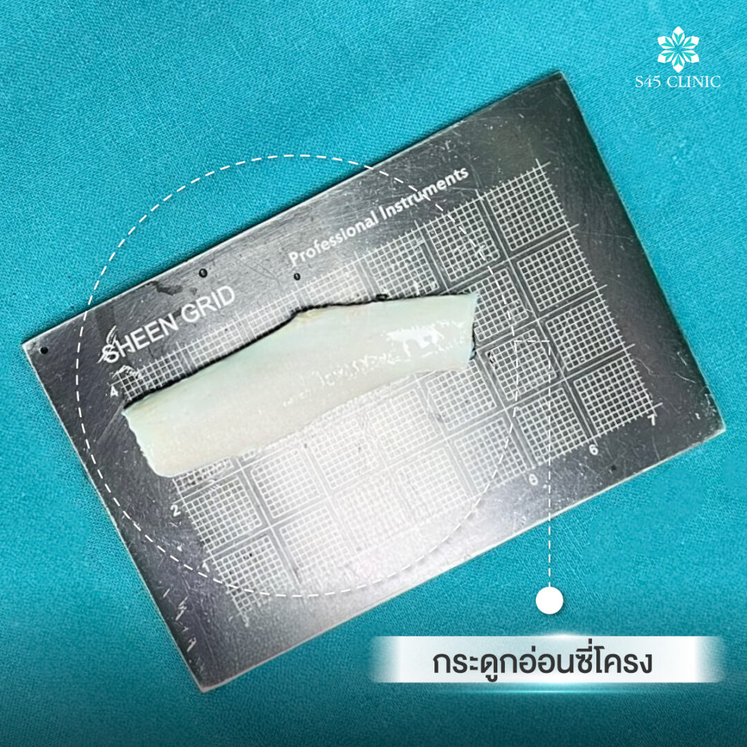 แผลเสริมจมูก Open ซี่โครง อยู่ตรงไหน มองเห็นชัดไหม? 2 แผลเสริมจมูก open 01