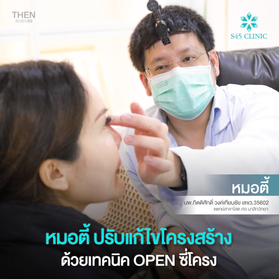 แผลเสริมจมูก open 010