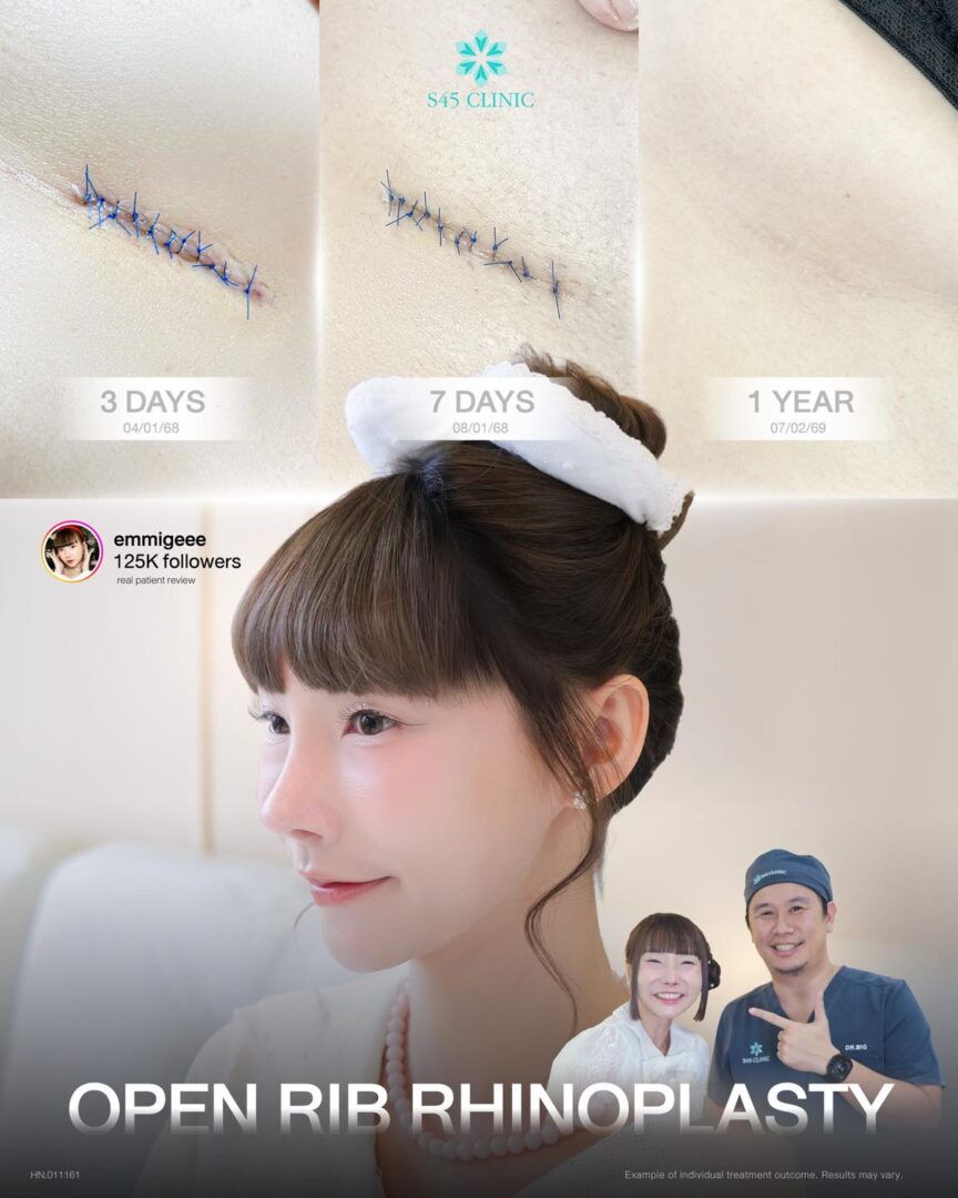แผลเสริมจมูก Open ซี่โครง อยู่ตรงไหน มองเห็นชัดไหม? 6 แผลเสริมจมูก open 011