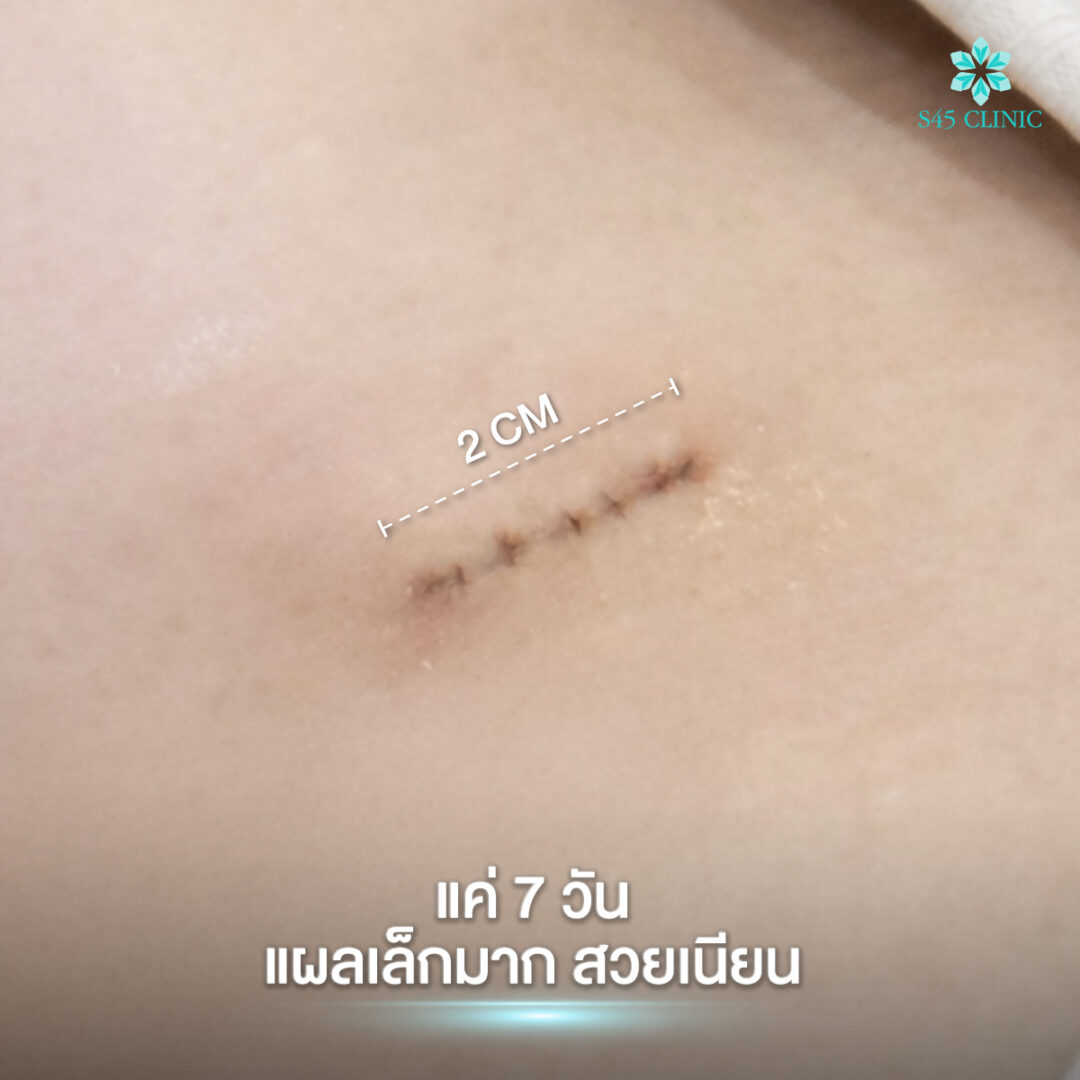 แผลเสริมจมูก Open ซี่โครง อยู่ตรงไหน มองเห็นชัดไหม? 3 แผลเสริมจมูก open 02