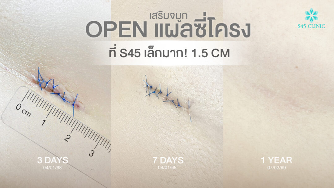 แผลเสริมจมูก Open ซี่โครง อยู่ตรงไหน มองเห็นชัดไหม? 5 แผลเสริมจมูก open 03