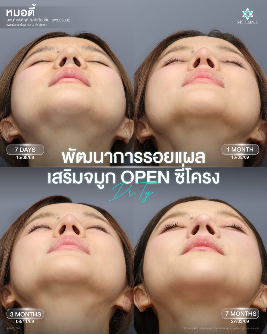 แผลเสริมจมูก open 04