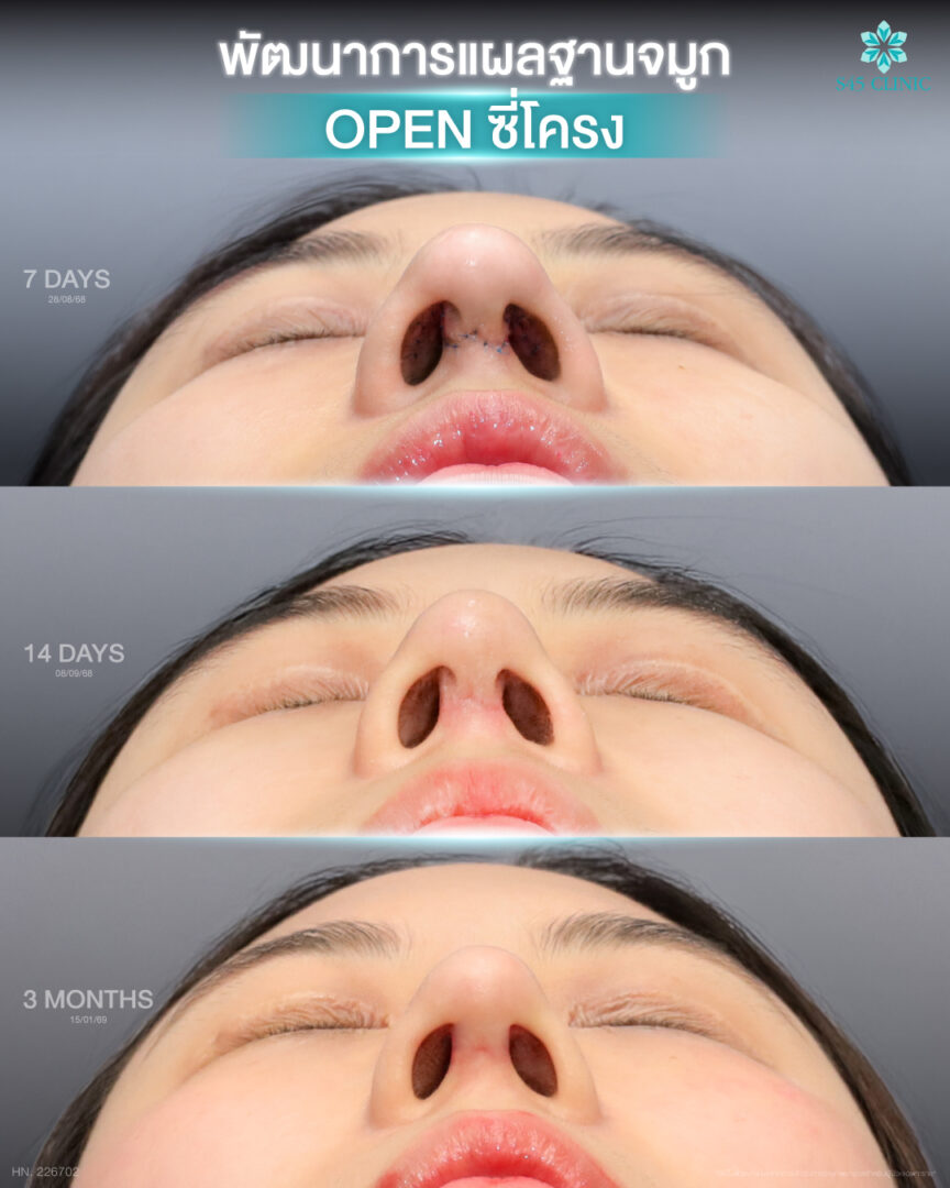 แผลเสริมจมูก open 07