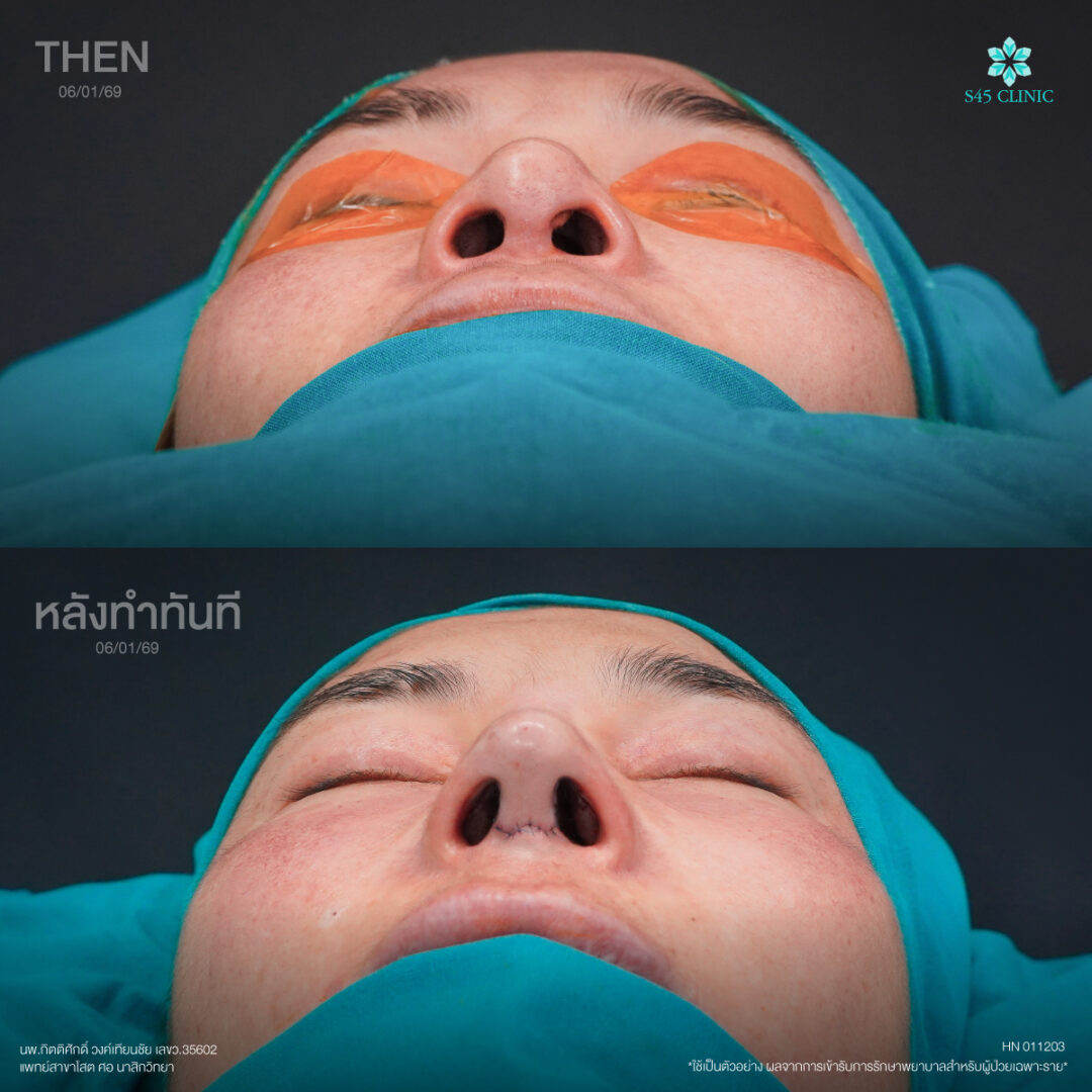 แผลเสริมจมูก open 09