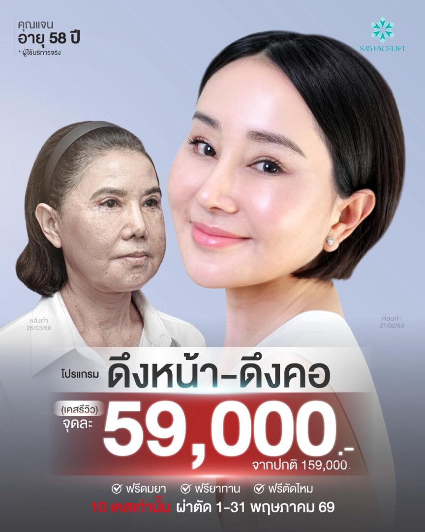 Promotion โปรโมชั่น เสริมจมูก แก้จมูก ราคาคุ้มค่า S45 Clinic จัดโปรให้ 9 โปรโมชั่นยกคิ้ว ดึงหน้า