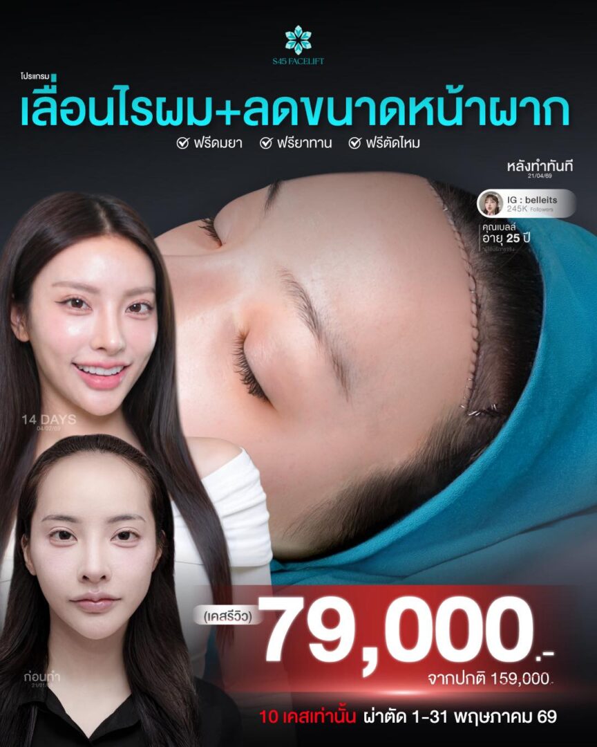 Promotion โปรโมชั่น เสริมจมูก แก้จมูก ราคาคุ้มค่า S45 Clinic จัดโปรให้ 8 โปรโมชั่นเลื่อนไรผม-ลดขนาดหน้าผาก