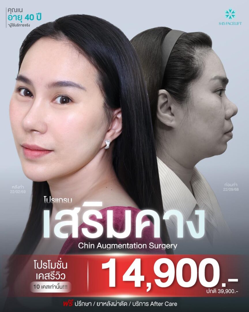 Promotion โปรโมชั่น เสริมจมูก แก้จมูก ราคาคุ้มค่า S45 Clinic จัดโปรให้ 11 โปรโมชั่นเสริมคาง