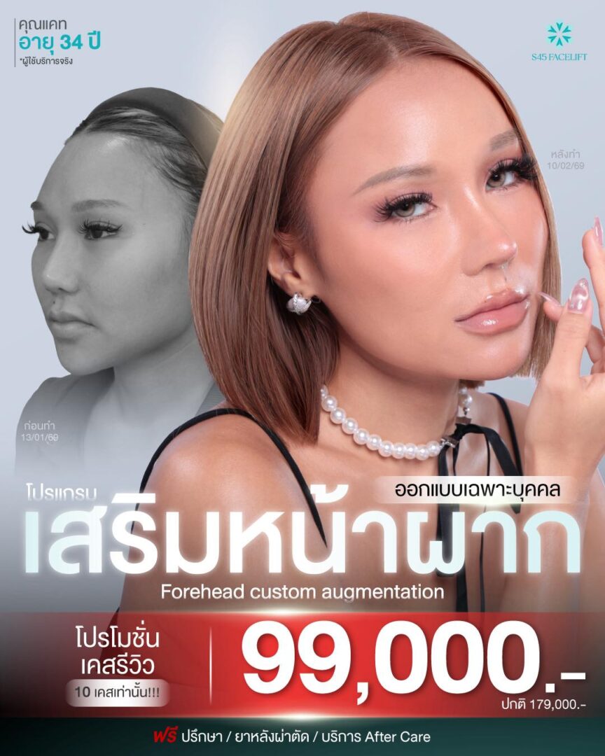 Promotion โปรโมชั่น เสริมจมูก แก้จมูก ราคาคุ้มค่า S45 Clinic จัดโปรให้ 10 โปรโมชั่นเสริมหน้าผาก