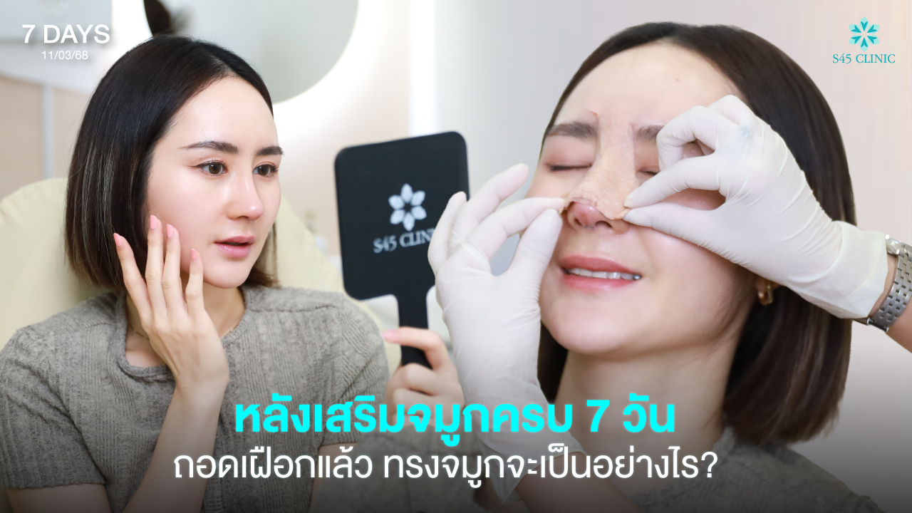 7 days after open rhinoplasty s45clinic