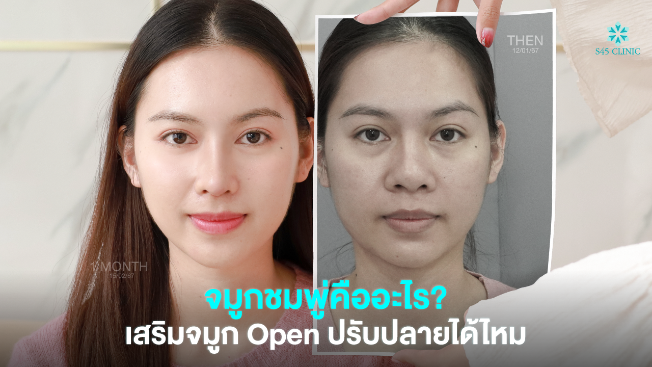 bulbous nose open rhinoplasty