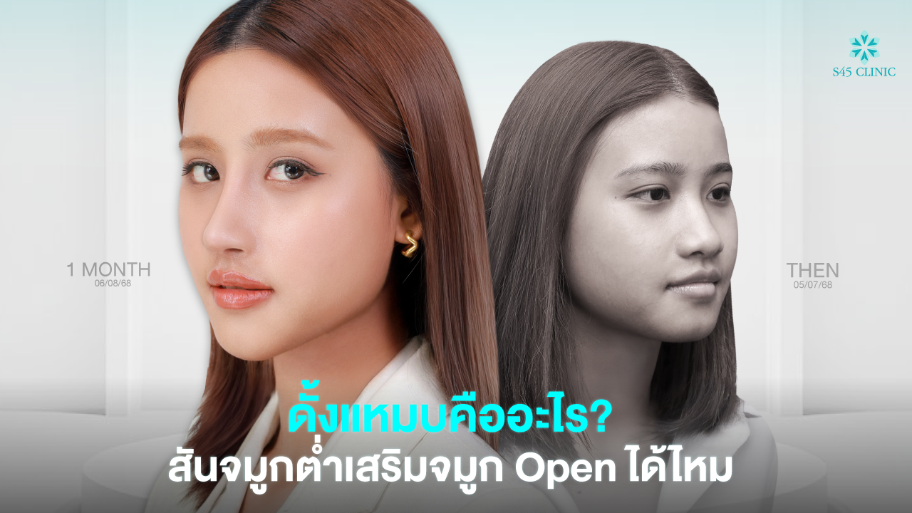 danghamb low nose bridge open rhinoplasty