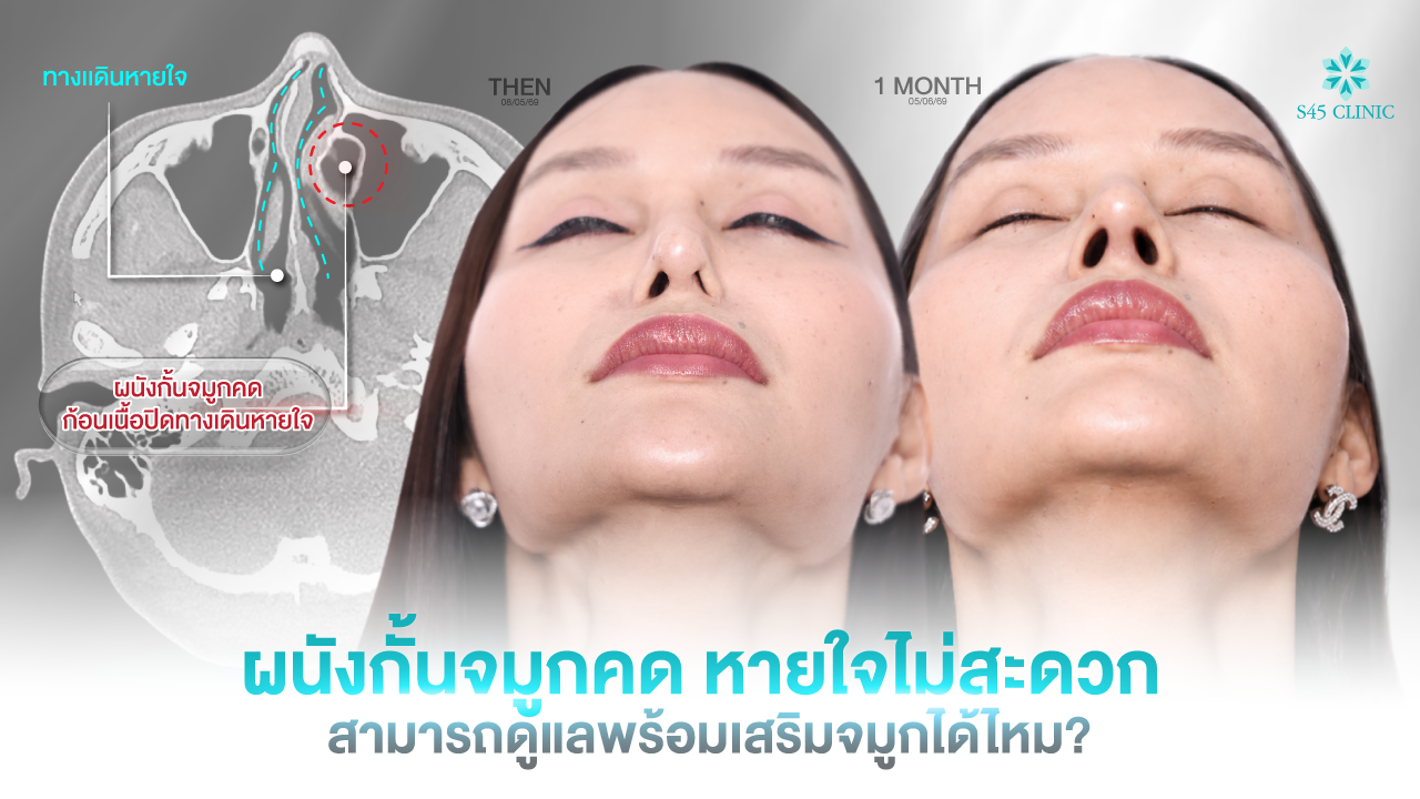 deviated septum nose structure s45clinic